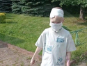 9-летнему мальчику, лицо которого съели собаки в Сочи, восстановили нос