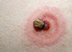 На петербурженку в Сочи "напал " клещ