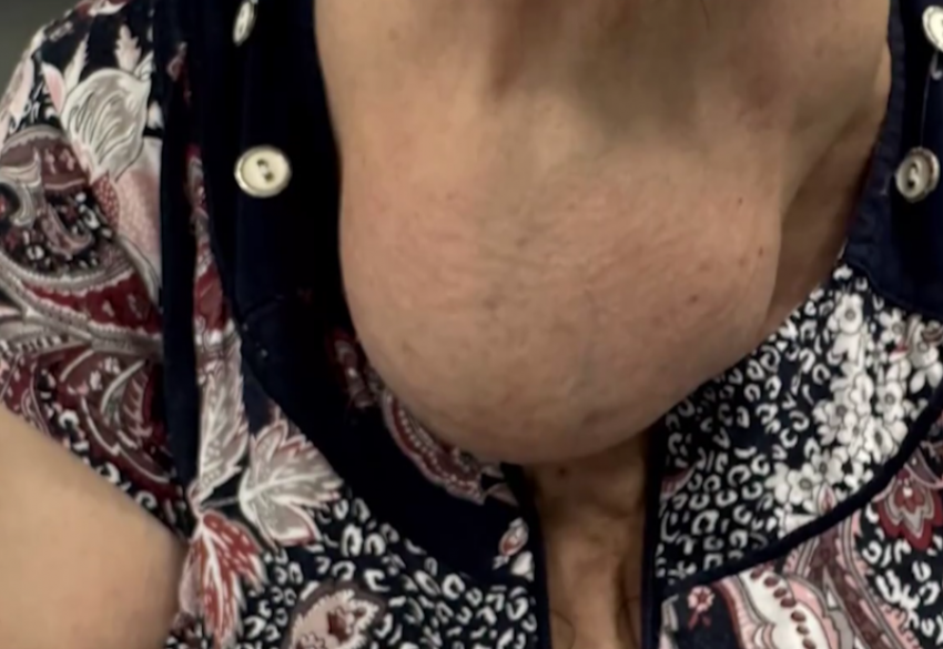 Полутораметровую опухоль удалили врачи у пациентки в Сочи